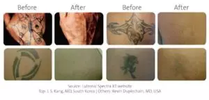 Tattoo Removal Before After
