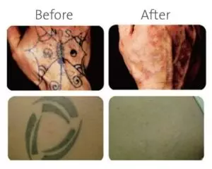 Tattoo Removed 01