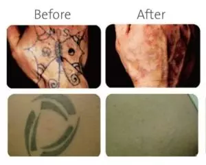 Tattoo Removed Photo 01