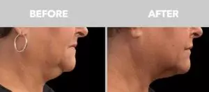 CoolSculpting Before After Double Chin 04
