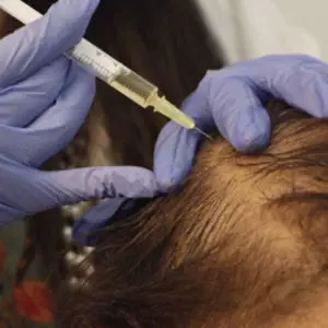 PRP Treatment