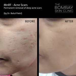 permanent removal of deep acne scars - mnrf treatment