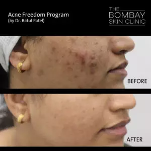 severe acne on face treatment
