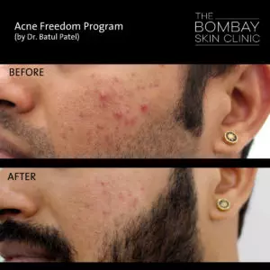 Cheek Acne Treatment