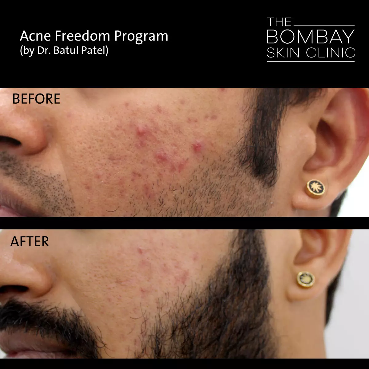Cheek Acne Treatment