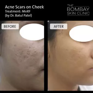 acne scars on cheek treatment - mnrf