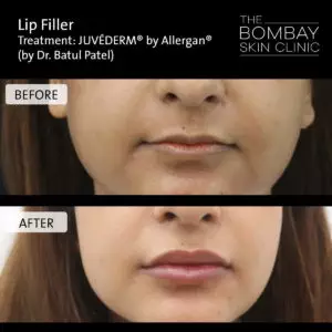 lip filler treatment