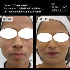 face enhancement treatment