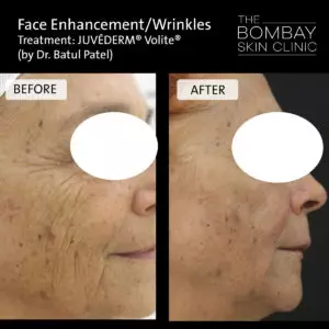 face wrinkles treatment
