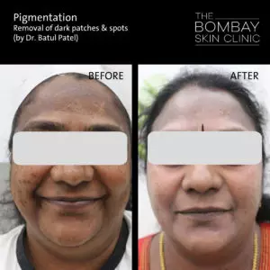 Pigmentation treatment