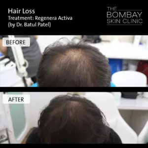 hair loss treatment