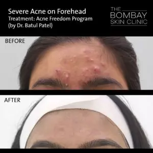 Forehead Acne Treatment