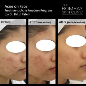 Cheek Acne Treatment before and after sessions