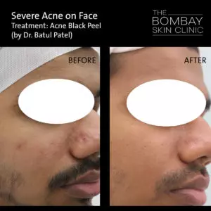 acne black peel treatment