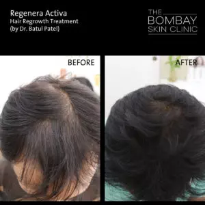 Regenera Activa Results 01