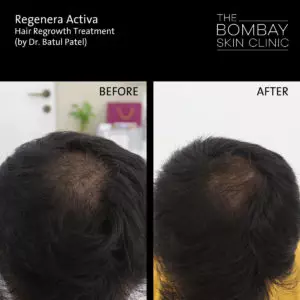 hair regroth treatment