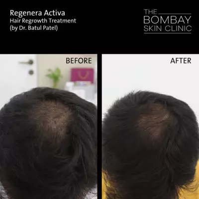 Regenera Activa Results 02