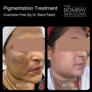 Cosmelan Mumbai Before After