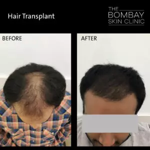Hair Transplant Mumbai
