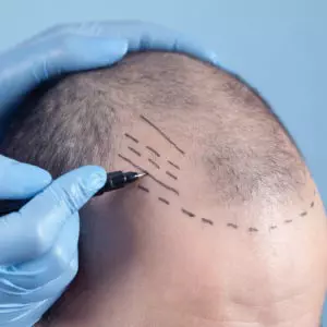 hair transplant
