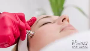 microdermabrasion treatment