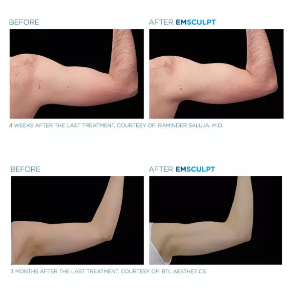 emsculpt before after mumbai emsculpt before after mumbai